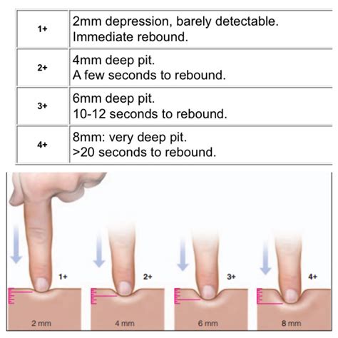 Pitting Edema Chart