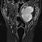 Pleomorphic Adenoma MRI