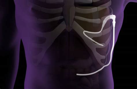 Pleural Dynamics reports positive data for automatic effusion shunt