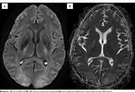 Encephalopathy Syndrome MRI Diffusion