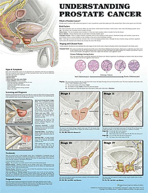 Prostate Tumor Size Chart