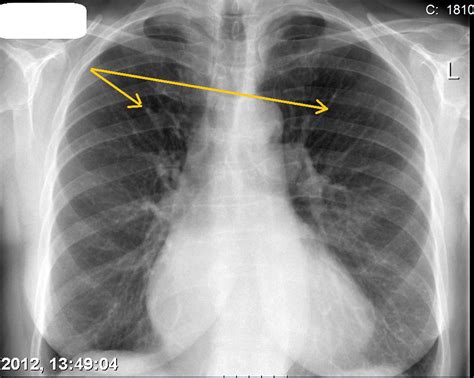 Pulmonary Edema