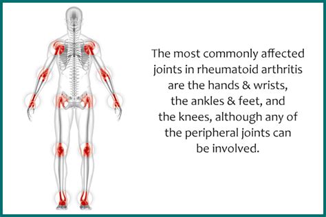 Joints Affected