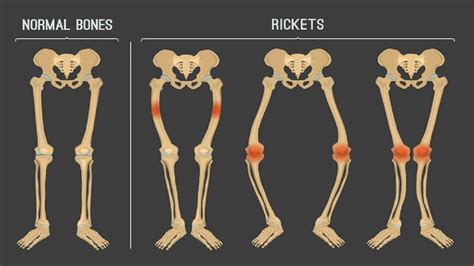 Rickets Chart