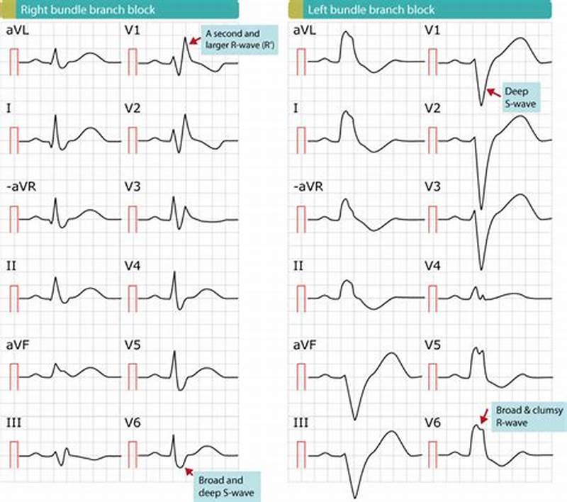 Right Bundle Branch Block Pattern