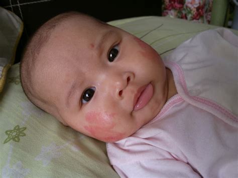 Ruam Susu Bayi