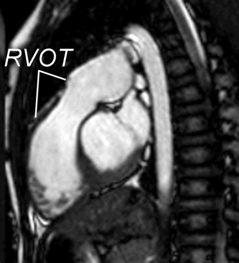 MRI