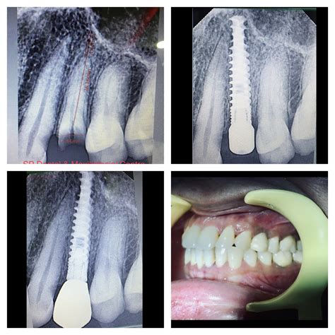 SP Dental and Maxillofacial Centre (Best Dental Clinic/Jaw Fracture treatment)
