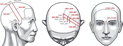 Scalp Acupuncture Points Chart