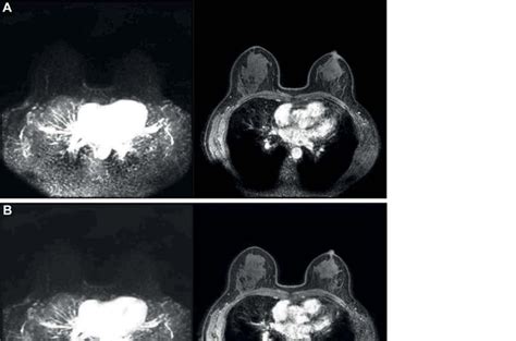 Shorter MRI Protocol Effective for Cancer Screening in LFS