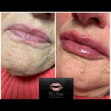 Skin Rejuvenation Clinic lip fillers anti-wrinkle injections dermaplane chemical peels