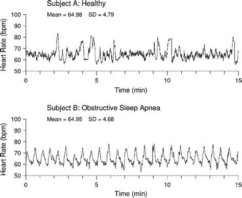 Sleep Apnea Heart Rate Chart