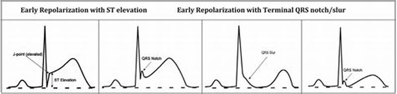 St Elev Probable Normal Early Repol Pattern