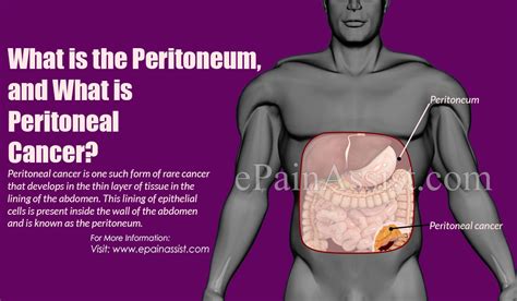 Peritoneal Cancer