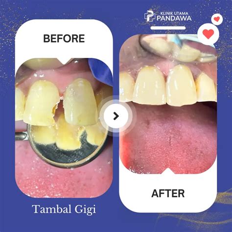 Tambal Gigi