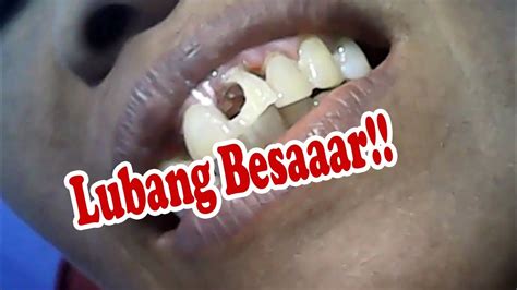 Berapa Biaya Tambal Gigi Berlubang Parah di Indonesia