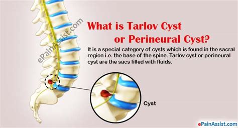 Tarlov Cyst Size Chart