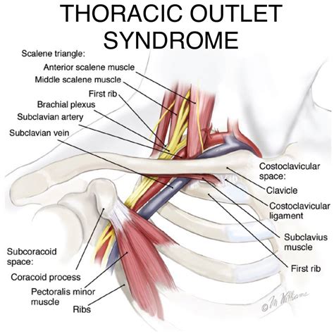 Outlet Syndrome TOS