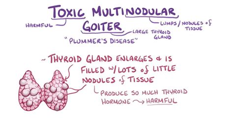 Toxic Multinodular … 