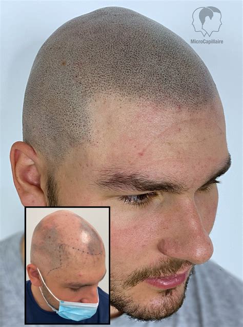 Tricopigmentation Hairline Geffroy Tatouage capillaire à Lannion