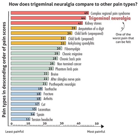 Trigeminal Neuralgia Pain Chart
