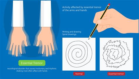 Ulixacaltamide Improves Daily Function in Patients With Essential Tremor