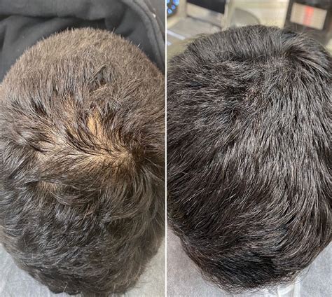 Ultimate Scalps - Hair Replacement Treatment Liverpool