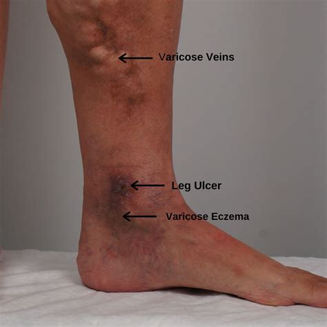 Veins Ulcers Legs