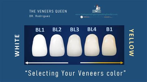 Veneers Color Chart
