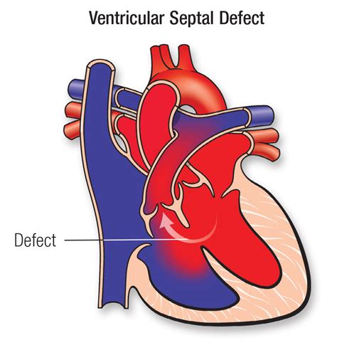 Septal Defect Heart