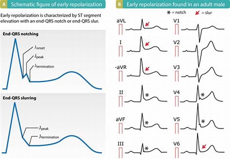 What Is Probable Normal Early Repol Pattern