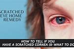 What to Do for a Scratched Cornea