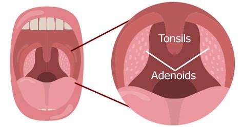 Tonsils/Aden… 