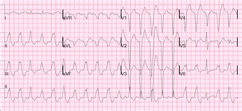 Tachycardia ECG Strip