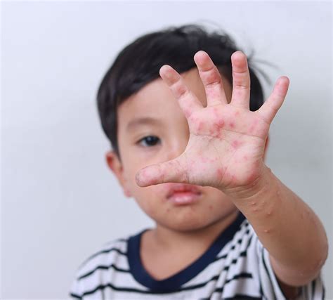 anak campak