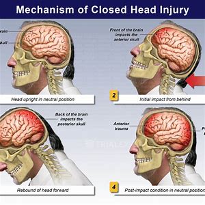 closed brain injury