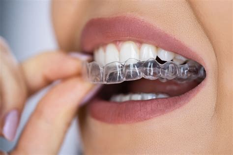 dental retainers