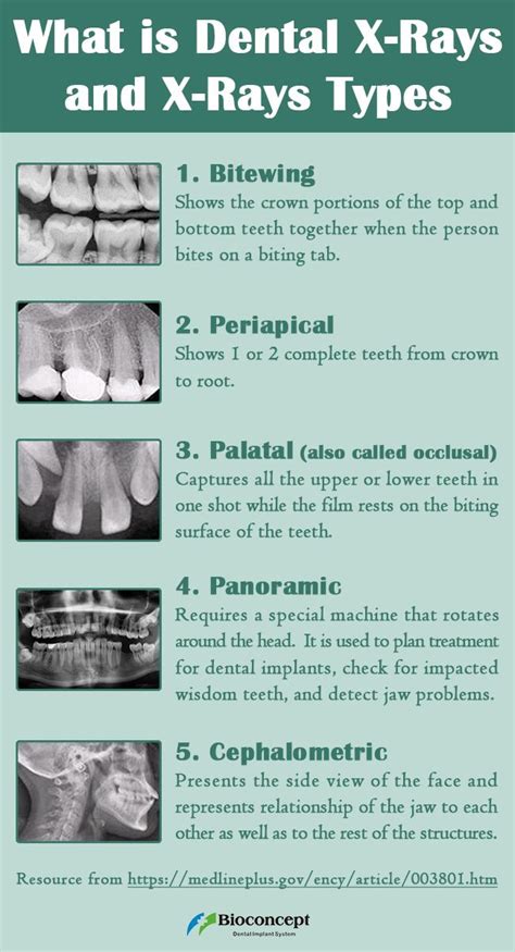 dental x-ray types image