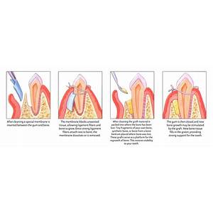 guided tissue regeneration for periodontitis