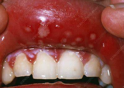 Herpes
