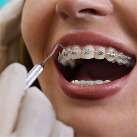 orthodontics teeth