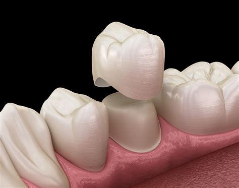 risk of complications with dental crown